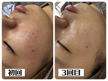 ハオン(HAON)/ハーブピーリング/ニキビ/毛穴