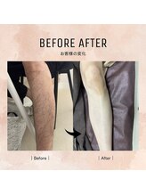 ルミエールブランシュ(Lumiere blanche)/足脱毛