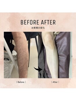 ルミエールブランシュ(Lumiere blanche)/足脱毛