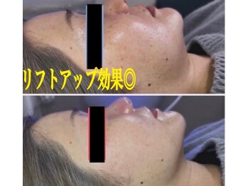 美的アヴェニール(美的.Avenir)の写真/リフトアップ+引き締めに!プラズマシャワー×EMS(筋肉刺激)×RF(コラーゲン生成)