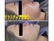 美的アヴェニール(美的.Avenir)の写真/リフトアップ+引き締めに!プラズマシャワー×EMS(筋肉刺激)×RF(コラーゲン生成)