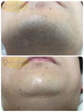 アン リオン(UN LiON)/顔全体10回