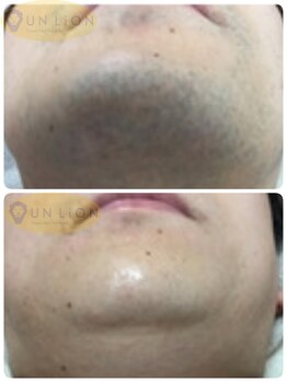 アン リオン(UN LiON)/顔全体10回