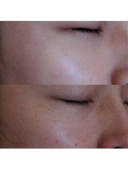 エトル(etole)/30代お客様症例写真