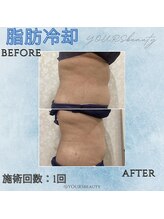 ユアーズ ビューティー(YOURS beauty)/脂肪冷却