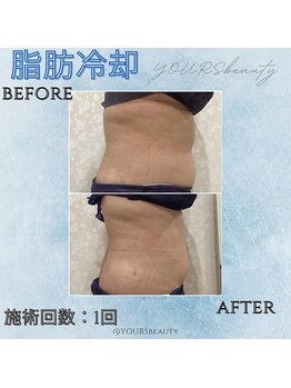 ユアーズ ビューティー(YOURS beauty)/脂肪冷却