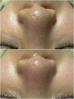 エステルーム クリスタル/【NEW】プラズマニア×毛穴洗浄 