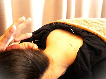 歩鍼灸院整骨院の写真/【鍼×整体¥4500～】手技ではとれにくい深層の悪い個所も鍼との組み合わせで根本改善◎《無料駐車場完備》