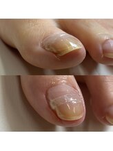 リリ(lili)/巻き爪矯正3回目（左親指）