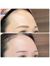 【丸みのあるおでこ】若見え♪額ヒアルリッチ注入