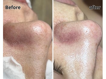 エヌエクラ(N.eclat.)/毛穴汚れ取り除くと、、