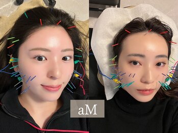 アム(aM)/むくみ・フェイスライン美容鍼