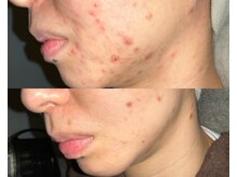 ル シーニュ/プロセルフェイシャル 美肌続く