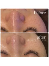 ブリス(BLiSS)/水素クレンジング＋カーボキシー