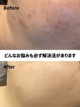 ハーブピーリング&毛穴洗浄専門店 肌REVO 高田馬場店[ニキビ/毛穴/たるみ/美白/シミ]&nbsp;長年の悩み 全て改善