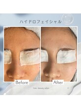リアン(Lien)/【症例】ハイドロフェイシャル