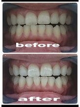 ヴェリー(Very)/セルフホワイトニング