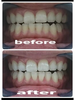 ヴェリー(Very)/セルフホワイトニング