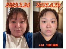 ハーボプラス(THE HEARBO plus)/施術例３