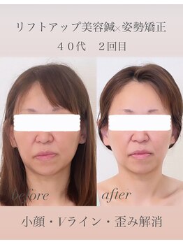 めい鍼灸院/リフトアップ美容鍼