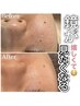 【最短で見違えるお肌に!!】毛穴エクストラクション＋肌質改善セット￥19800
