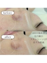 ケアプラス/毛穴縮小