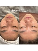 エステティックス ナインワンワン 横浜(Esthetics911) /水素+高周波でトーンアップ