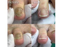 巻き爪補正店 豊田店/【分厚い爪／変形爪再生補正】