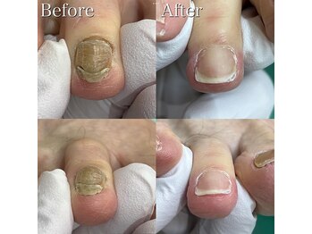 巻き爪補正店 豊田店/【分厚い爪/変形爪再生補正】