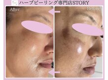 ストーリー 岐阜店(STORY)/ハーブピーリング専門店STORY