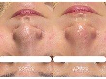 リス ブラン(Lys Blanc)/ハイドラフェイシャル