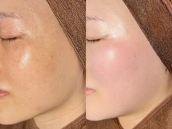 ルーナジェーナ(Luna llena)の写真/池袋駅東口｜好印象の決め手はツヤ肌！30代からの”素肌力革命”顔脱毛でトーンアップ＆毛穴レスな美肌に