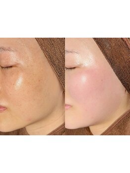 顔脱毛がしたい