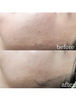 ル クラージュ(Le courage)/バクテリウムピール(20代女性)