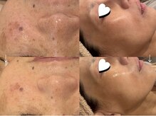 【シミくすみ改善・ハリツヤUP】ピーリング/エンビロンで美肌に