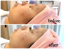 シルク(Cilk)/ハリ、ツヤ、リフトアップ◎