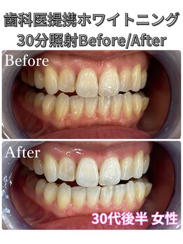 プラチナムビューティ 四条烏丸店(PLATINUM Beauty)/ホワイトニング!Before./After!
