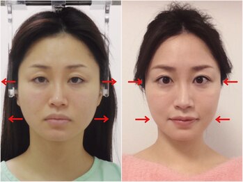 さつま骨格矯正 渋谷 恵比寿本院/歪み小顔矯正　継続矯正