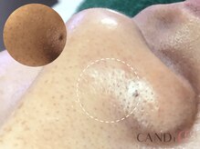 キャンディ 栄店(CANDi)/ハイドラピーリング/黒ずみ毛穴