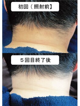 ビダンドウ(BIDANDO)/男女とも【注目度UP】うなじ脱毛