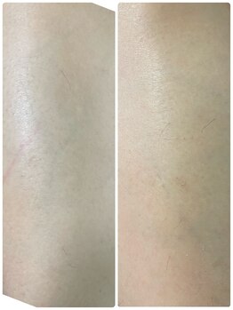 エン(en.)/Before After写真２