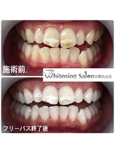 ホワイトニングサロン 京都烏丸店/ホワイトニング施術例