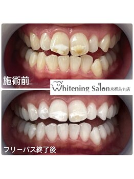 ホワイトニングサロン 京都烏丸店/ホワイトニング施術例