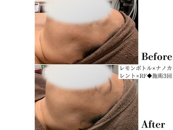 フレイヤ(FREYA)/レモンボトルBefore→After