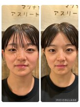 ひだまり鍼灸整骨院/お客様Before／After小顔効果