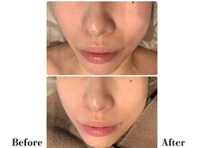 フレイヤ(FREYA)/ララピールBefore→After