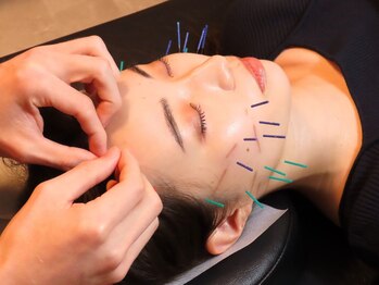 アム(aM)/むくみ・フェイスライン美容鍼