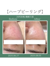 ロク(roku,)/ハーブピーリング