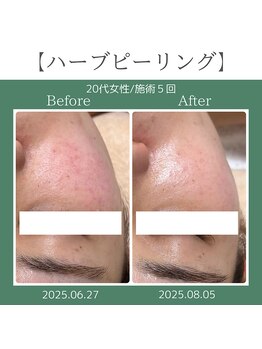 ロク(roku,)/ハーブピーリング