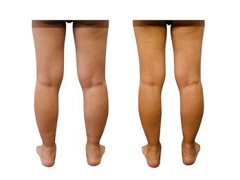 ベンザイ 梅田店(BENZAI)/術後に足のむくみで悩む